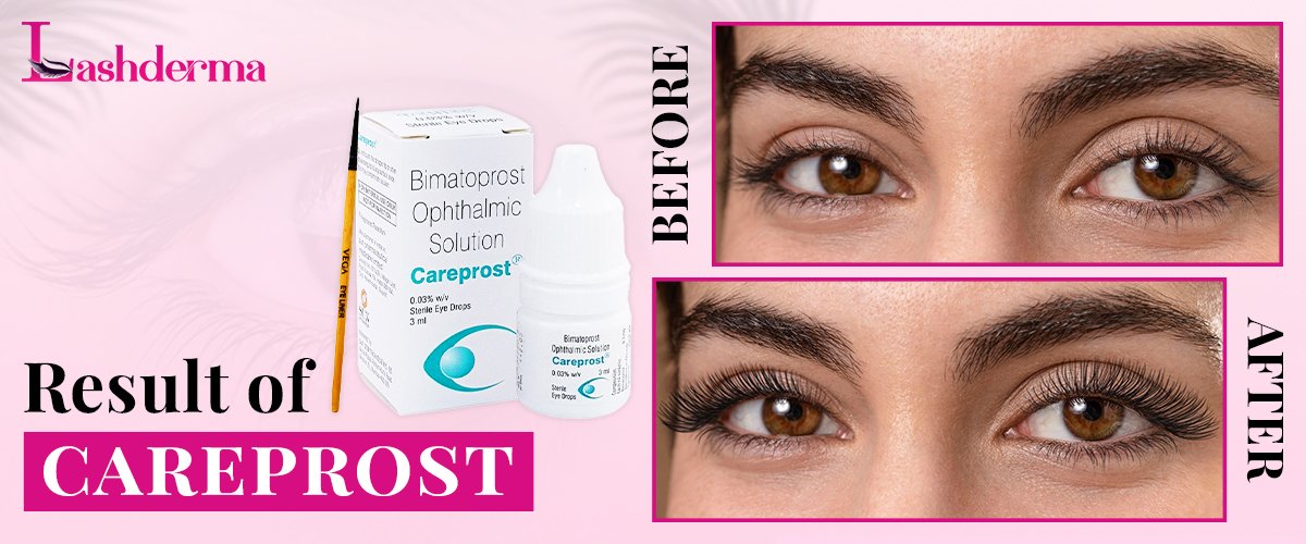 Careprost 3 careprost before after result